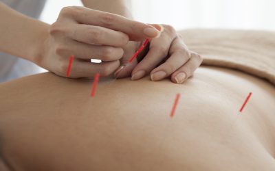 Transform Everyday Life Using Acupuncture For Pain in Union City, CA Solutions