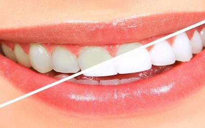 Transform Your Look with Expert Cosmetic Dentistry in Denver CO Tailored for You